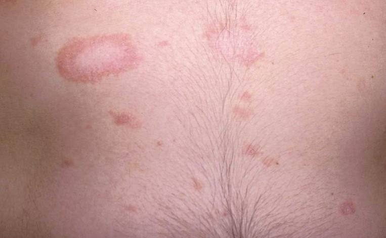 O pigmentary nota do bronzeado do sol em um corpo
